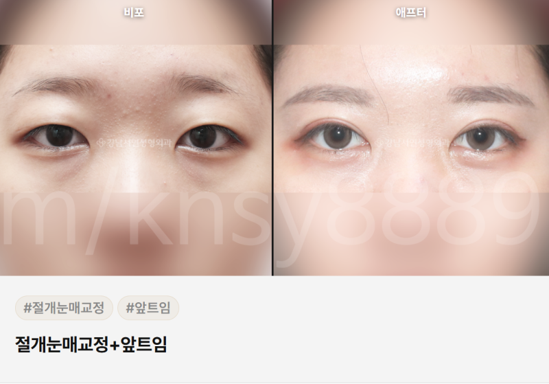 무쌍 눈매교정술, 쌍꺼풀 없이 눈매를 또렷하게 만들 수 있나요? 사진 7