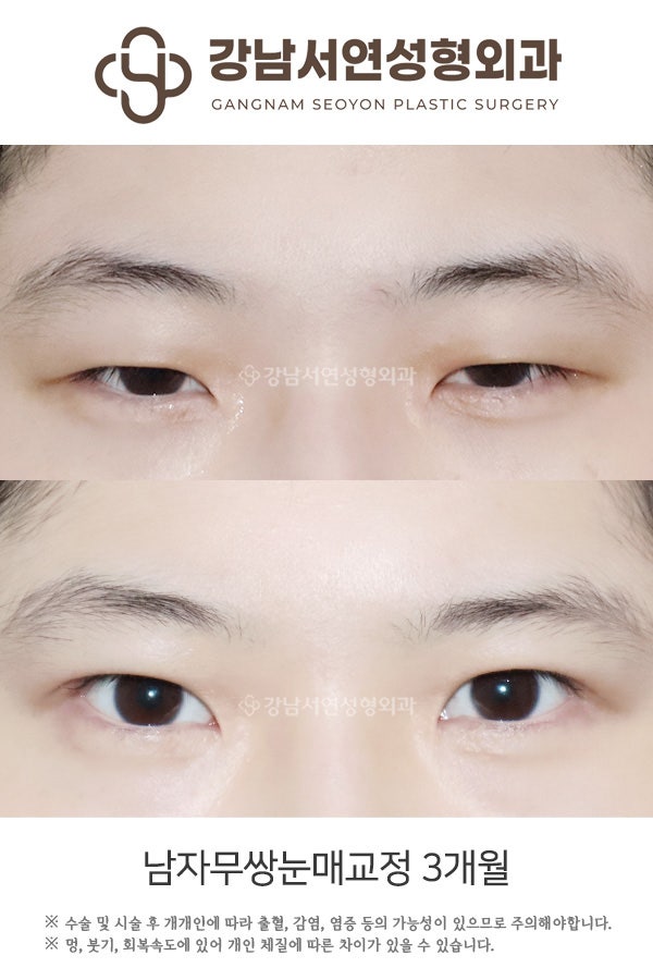 무쌍 눈매교정술, 쌍꺼풀 없이 눈매를 또렷하게 만들 수 있나요? 사진 2