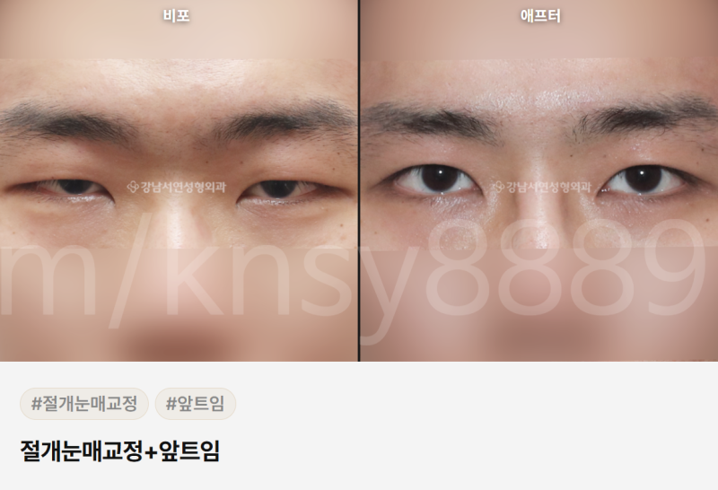 무쌍 눈매교정술, 쌍꺼풀 없이 눈매를 또렷하게 만들 수 있나요?