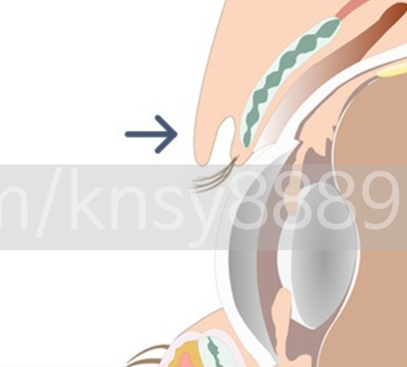 무쌍 눈매교정술, 쌍꺼풀 없이 눈매를 또렷하게 만들 수 있나요? 사진 5