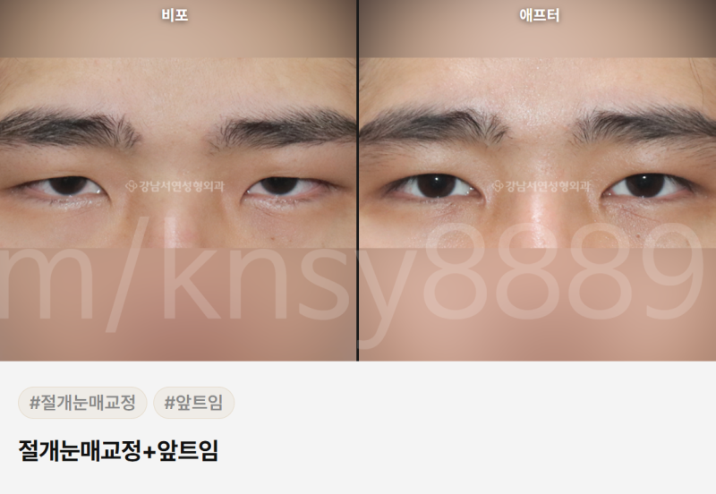 무쌍 눈매교정술, 쌍꺼풀 없이 눈매를 또렷하게 만들 수 있나요? 사진 8