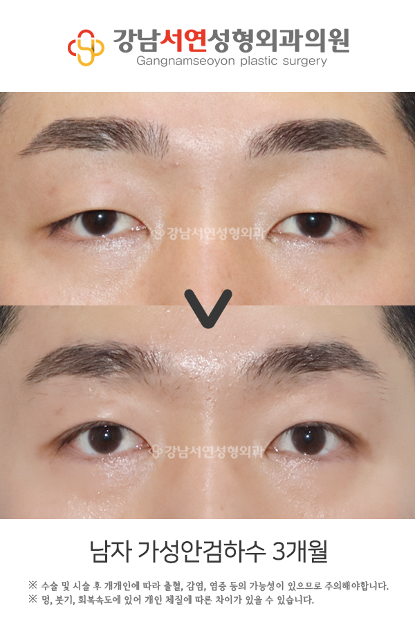 무쌍 눈매교정술, 쌍꺼풀 없이 눈매를 또렷하게 만들 수 있나요? 사진 15