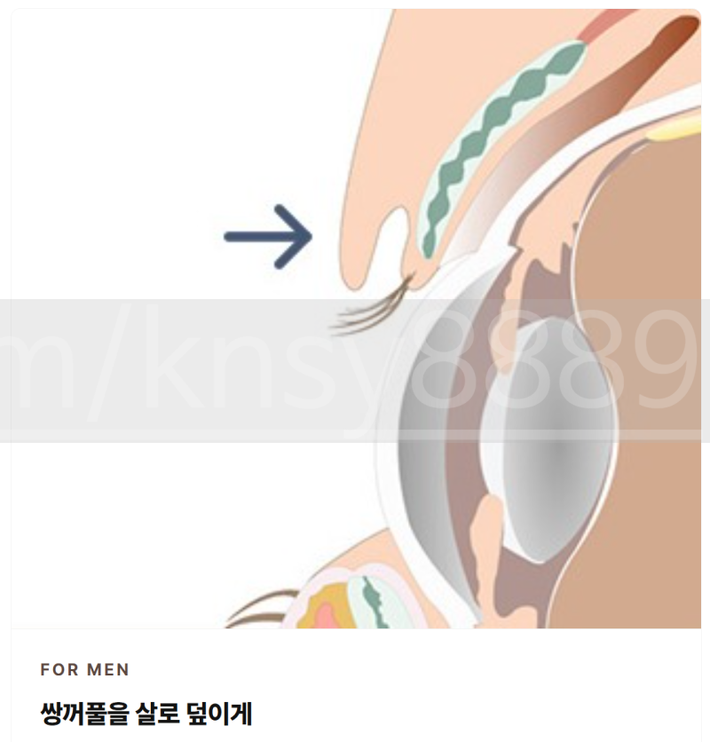 쌍꺼풀 없애는 수술, 남자에게 맞는 방법이 따로 있습니다 사진 2