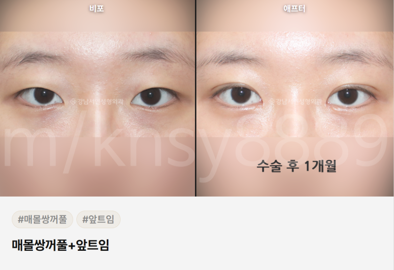 쌍수 매몰 절개 차이점, 처음 알아보는 분도 이 글 하나로 이해됩니다 사진 2