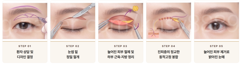 쌍수 매몰 절개 차이점, 처음 알아보는 분도 이 글 하나로 이해됩니다 사진 6