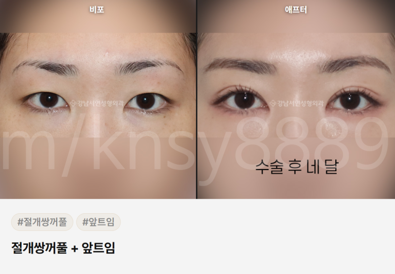 쌍수 매몰 절개 차이점, 처음 알아보는 분도 이 글 하나로 이해됩니다 사진 8