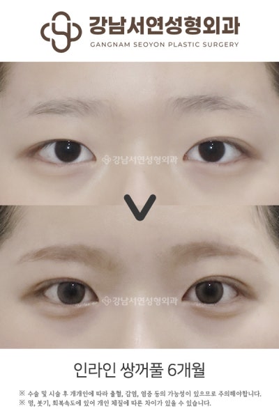 쌍수 매몰 절개 차이점, 처음 알아보는 분도 이 글 하나로 이해됩니다 사진 9