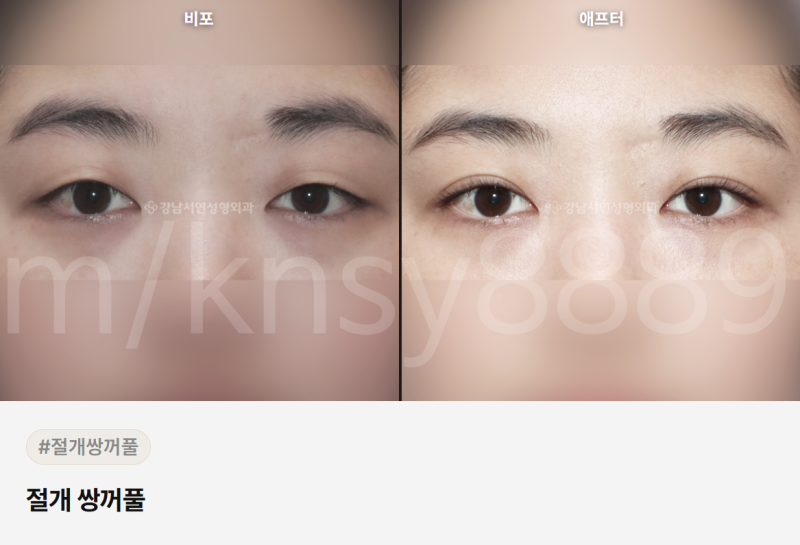 쌍수 매몰 절개 차이점, 처음 알아보는 분도 이 글 하나로 이해됩니다