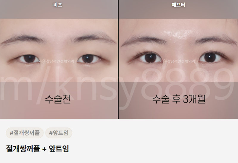 쌍수 매몰 절개 차이점, 처음 알아보는 분도 이 글 하나로 이해됩니다 사진 7