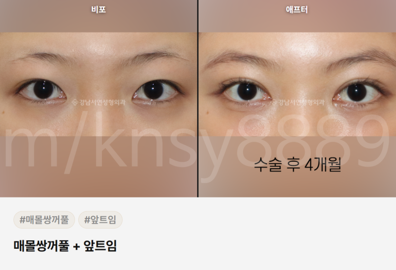 쌍수 매몰 절개 차이점, 처음 알아보는 분도 이 글 하나로 이해됩니다 사진 5