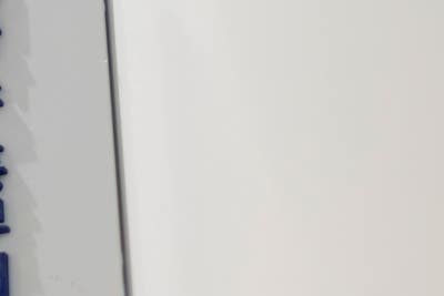 하지정맥류 원인 치료 안 하면 이렇게 진행 사진 14