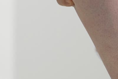 하지정맥류 생기는 혈관 다리정맥 사진 12