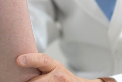 하지정맥류 생기는 혈관 다리정맥 사진 13
