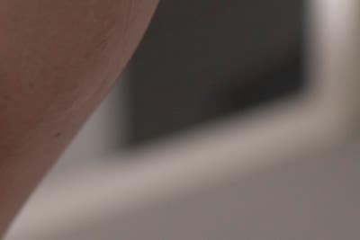 하지정맥류 질병, 반드시 치료해야 하는 이유 사진 13