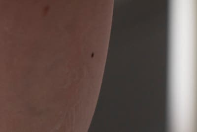 하지정맥류 질병, 반드시 치료해야 하는 이유 사진 10