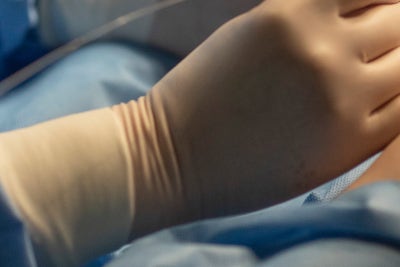 하지정맥류 원인, 관통정맥 부전 사진 15