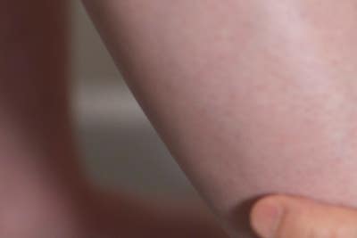 하지정맥류, 안 아파도 치료해야 하나요? 답을 알려드립니다 사진 12