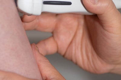 하지정맥류, 안 아파도 치료해야 하나요? 답을 알려드립니다 사진 13