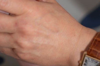 하지정맥류, 안 아파도 치료해야 하나요? 답을 알려드립니다 사진 16