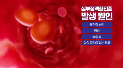 장거리 비행 앞두고 계시다면, 이코노미클래스 증후군(심부정맥혈전증) 조심하세요! 사진 5