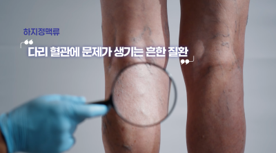 하지정맥류 있으면 치매 잘 생긴다? 논문 확인해보세요 사진 5