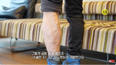 KNN 닥터스 하지정맥류 재발, 재수술 치료_김병준 원장