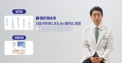 하지정맥류 수술 후 압박스타킹 신는 이유와 착용 기간 사진 6