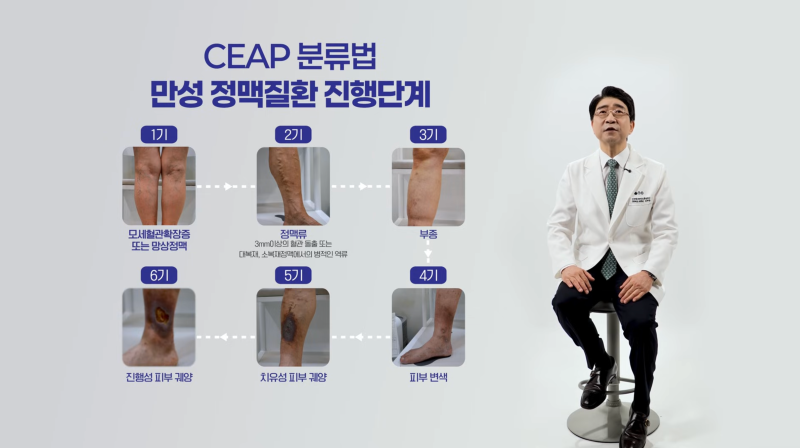 트럼프 대통령의 다리 부종, 만성 정맥부전?하지정맥류? 사진 6