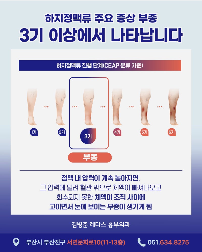서면하지정맥병원 저녁마다 양말 자국, 다리가 붓고 무겁다면? 사진 5