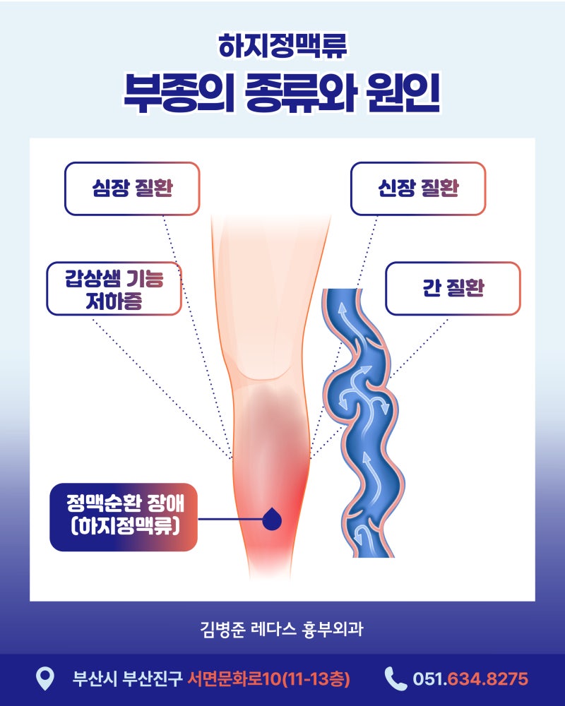 서면하지정맥병원 저녁마다 양말 자국, 다리가 붓고 무겁다면? 사진 3