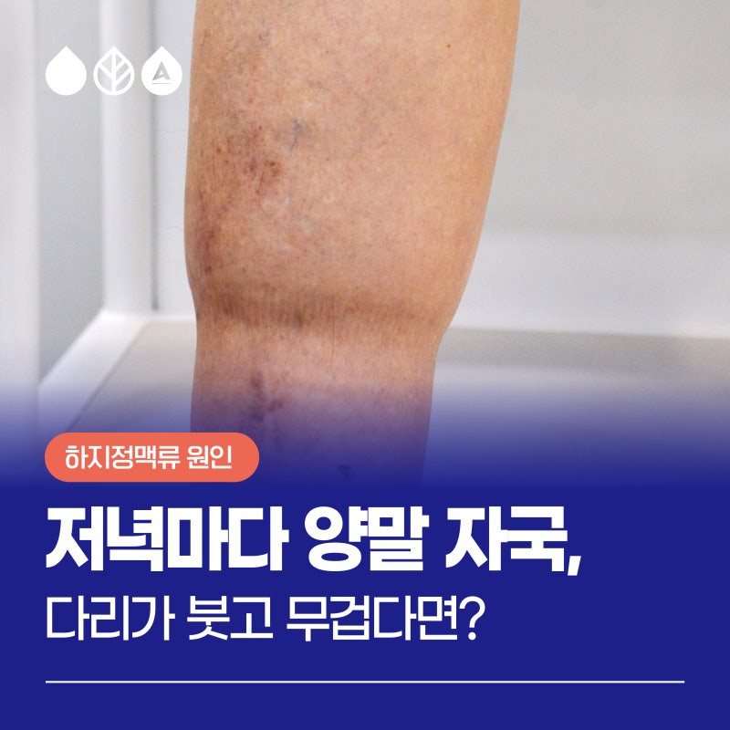 서면하지정맥병원 저녁마다 양말 자국, 다리가 붓고 무겁다면?