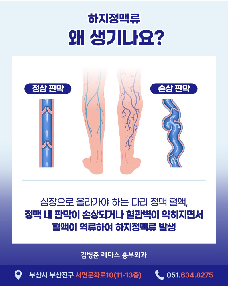 하지정맥류 있다면 꼭 알아야 할 좋은 운동, 나쁜 운동 사진 2