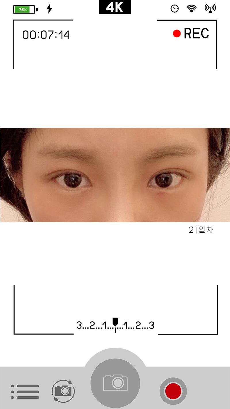 안검하수눈매교정 진가를 알려드립니다 사진 3