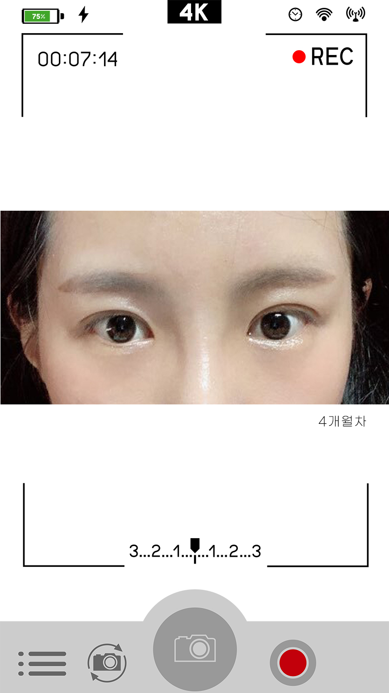 안검하수눈매교정 진가를 알려드립니다 사진 6