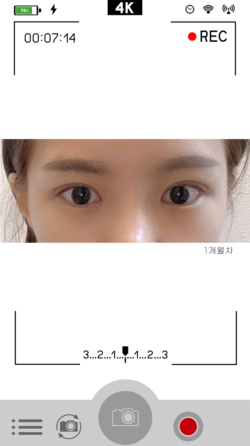 안검하수눈매교정 진가를 알려드립니다 사진 4
