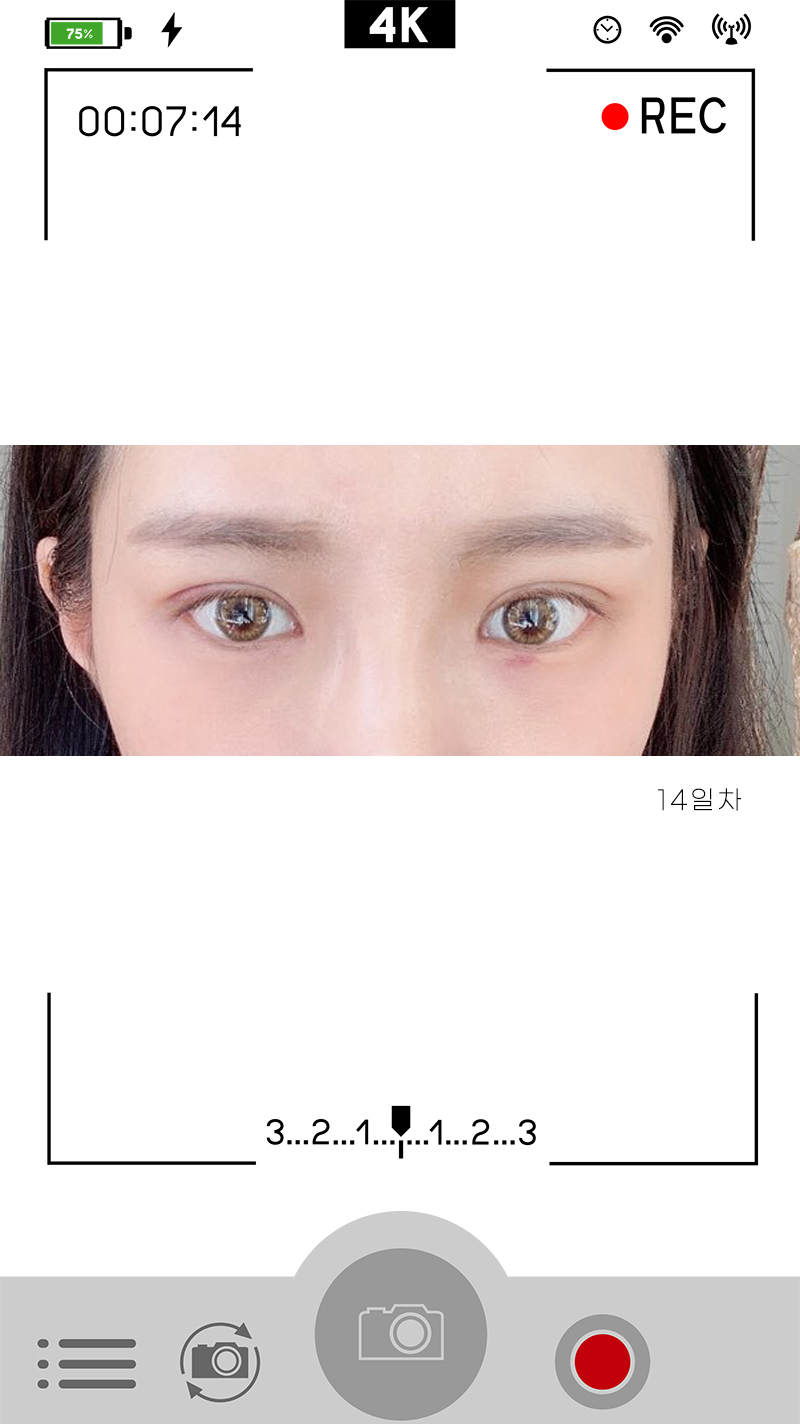 안검하수눈매교정 진가를 알려드립니다 사진 2