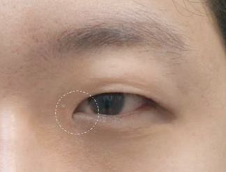 눈트임수술 다 해야할까요? 사진 3