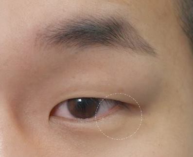 눈트임수술 다 해야할까요? 사진 11