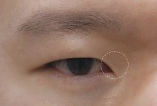 눈트임수술 다 해야할까요? 사진 7