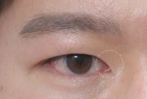 눈트임수술 다 해야할까요?