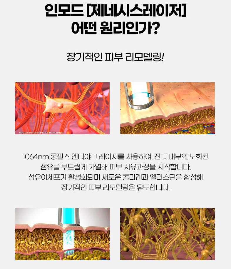 인모드 3단계? 원장님이 직접 시술합니다 사진 8