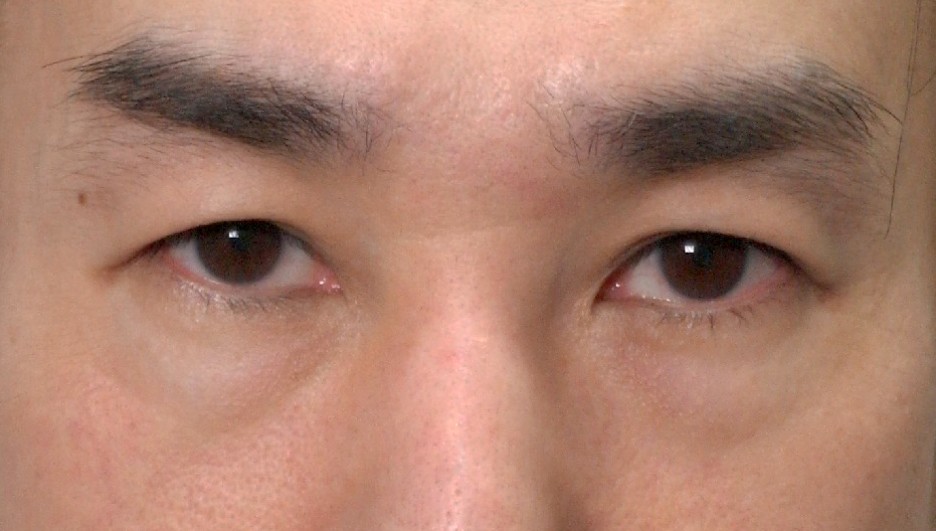 앙코르눈밑지 비대면상담 가능한 르미엘성형외과 사진 8