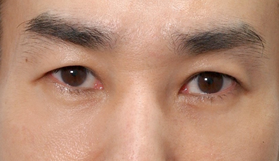 앙코르눈밑지 비대면상담 가능한 르미엘성형외과 사진 9