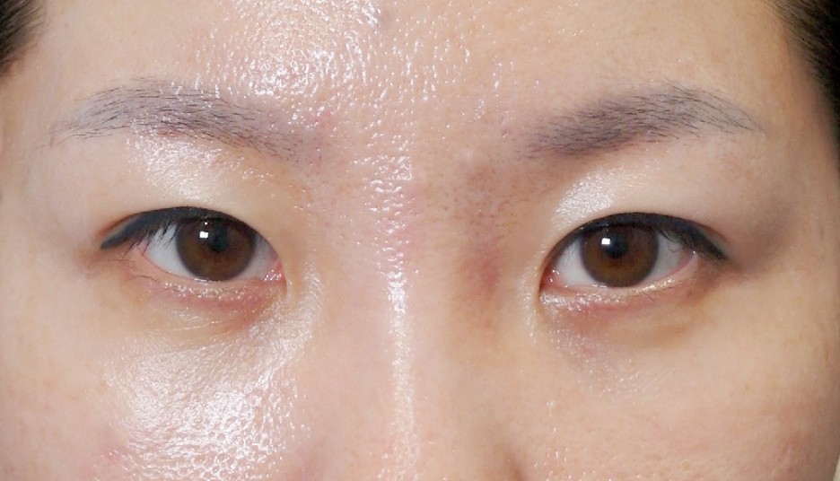 앙코르눈밑지 비대면상담 가능한 르미엘성형외과 사진 5