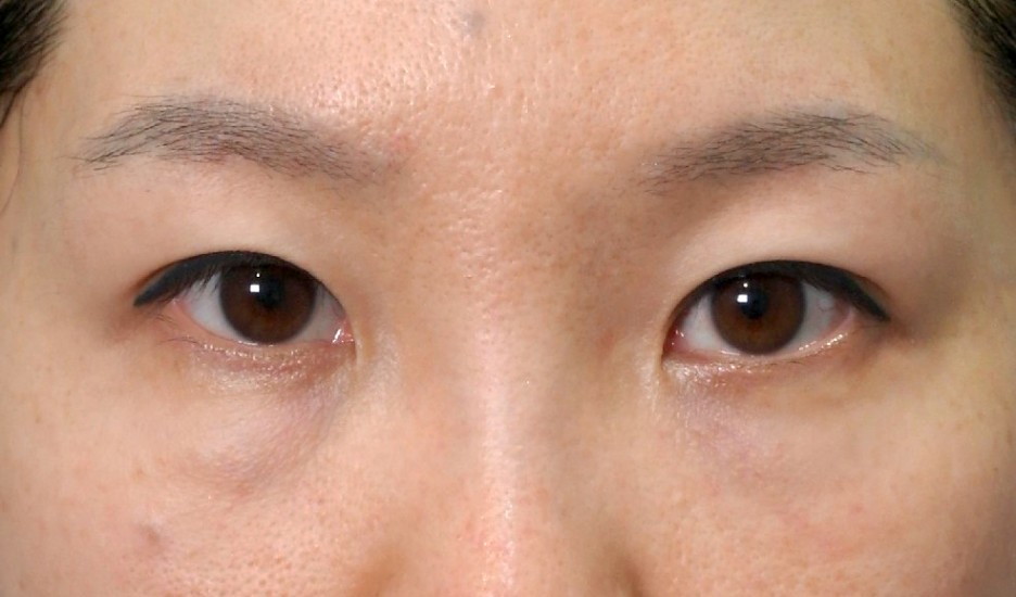 앙코르눈밑지 비대면상담 가능한 르미엘성형외과 사진 4