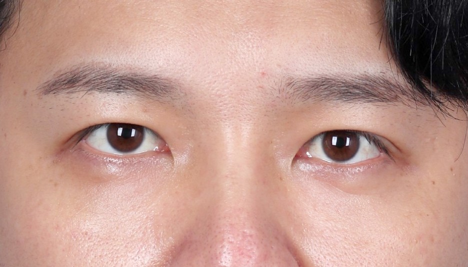 앙코르눈밑지 비대면상담 가능한 르미엘성형외과 사진 11
