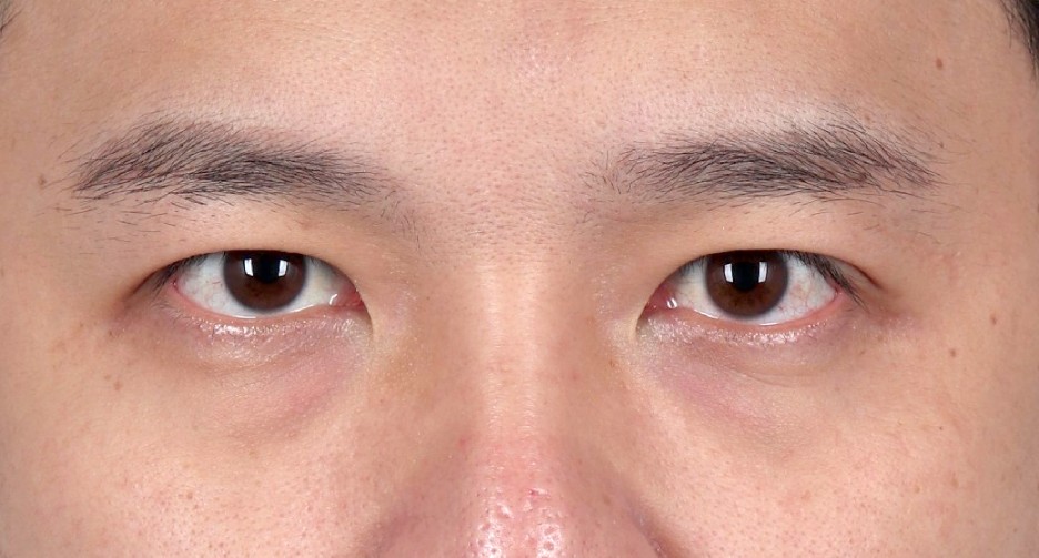 앙코르눈밑지 비대면상담 가능한 르미엘성형외과 사진 10