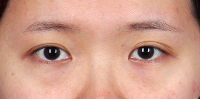 레이저눈밑지방재배치가격 교통정리 사진 2