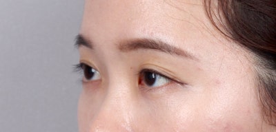 레이저눈밑지방재배치가격 교통정리 사진 4