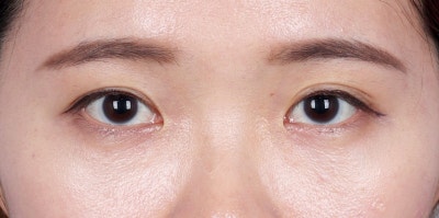 레이저눈밑지방재배치가격 교통정리 사진 5